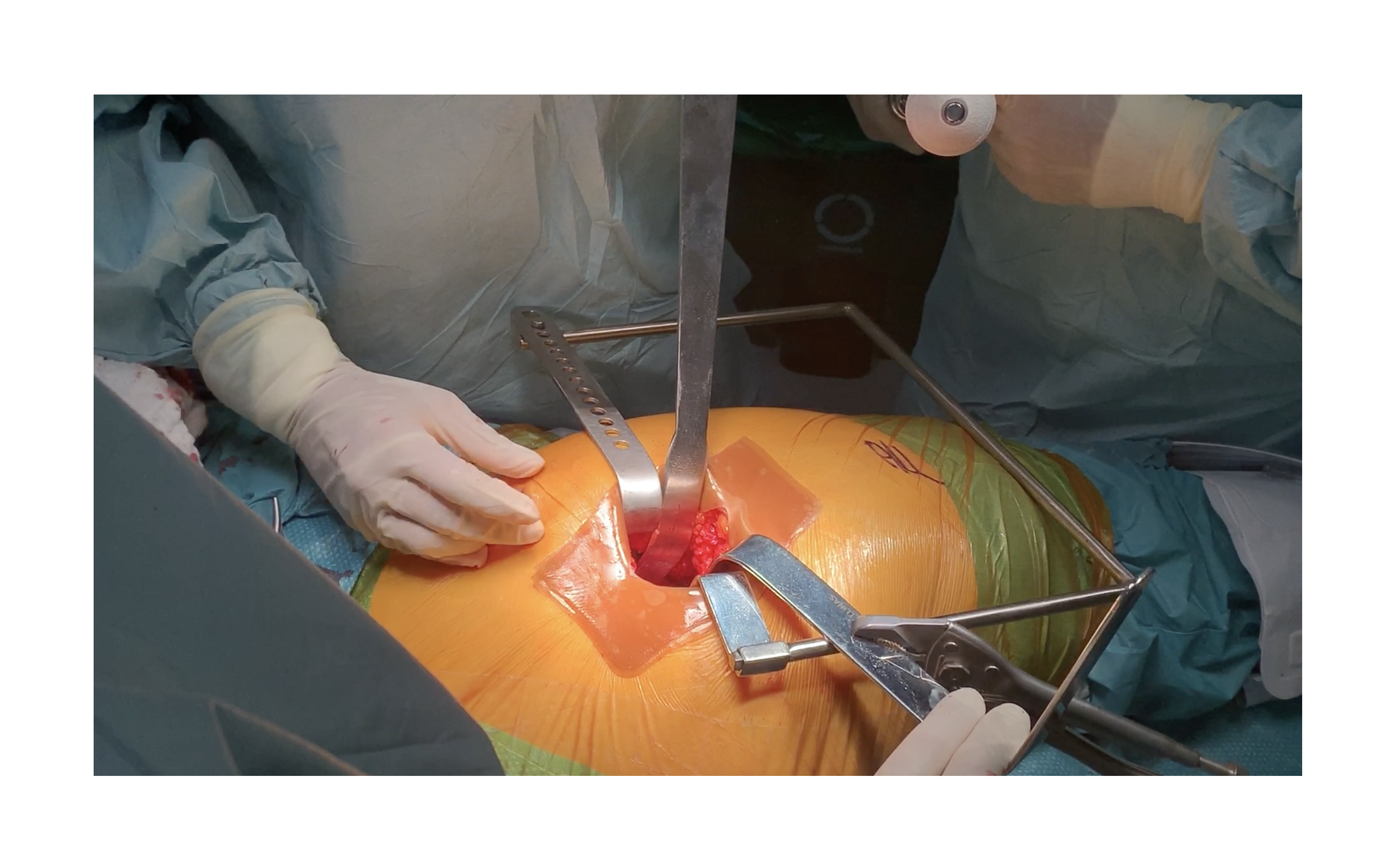 OR still: acetabular site open with retractors, no barrier in place