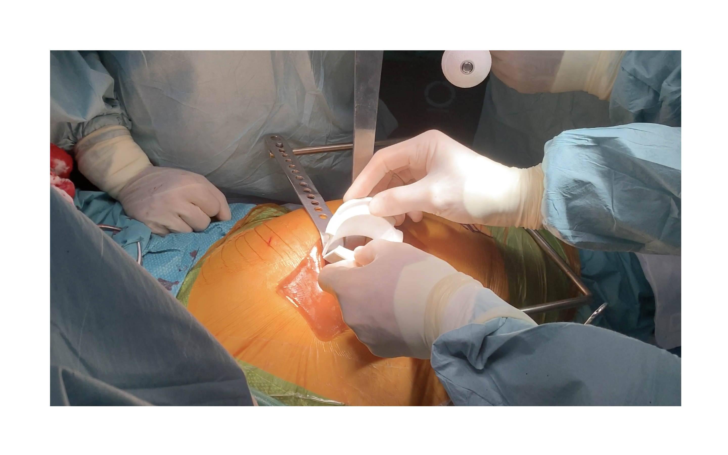 OR still: surgeon placing AcetGard around the acetabular rim