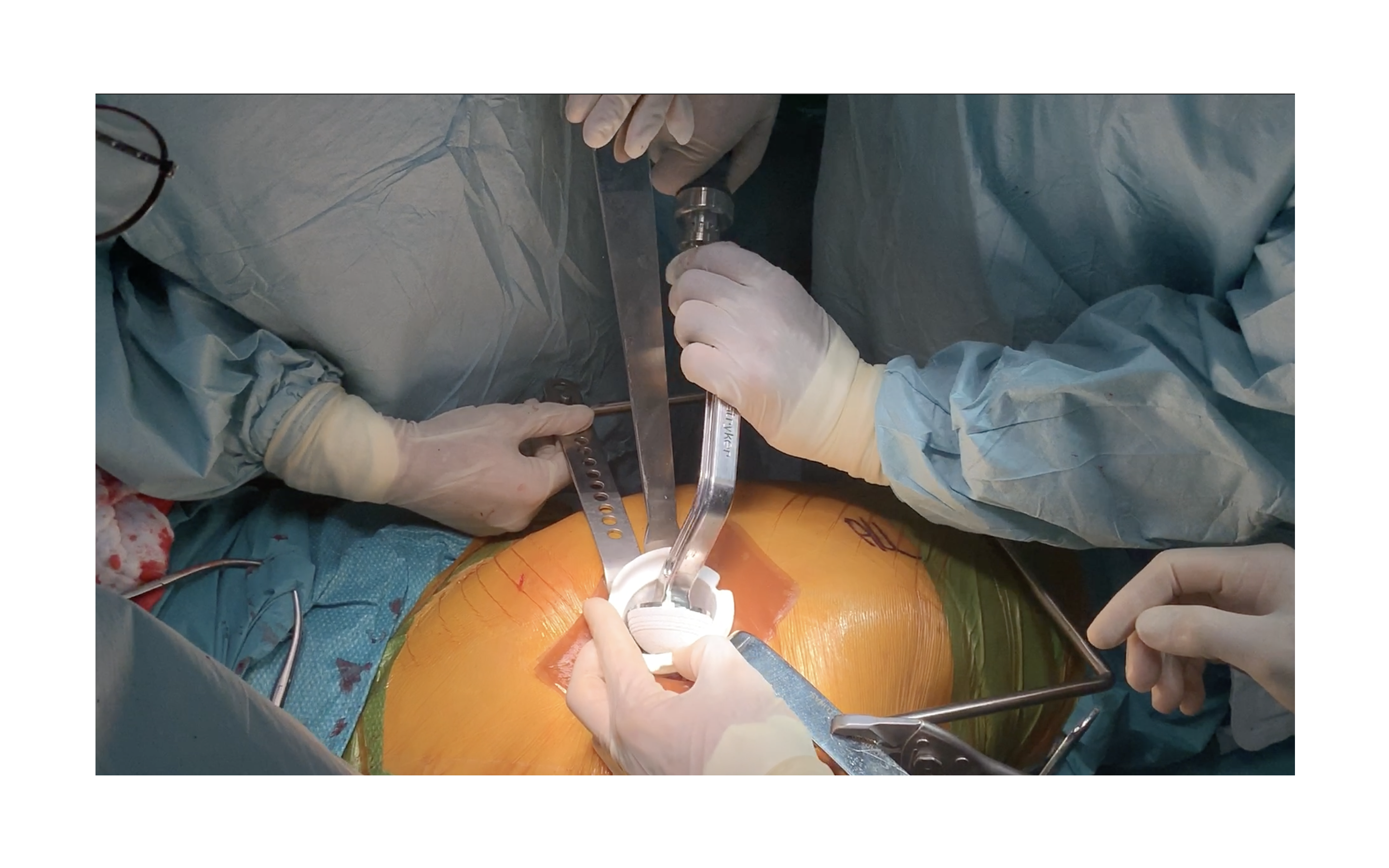 OR still: acetabular cup being impacted through AcetGard collar